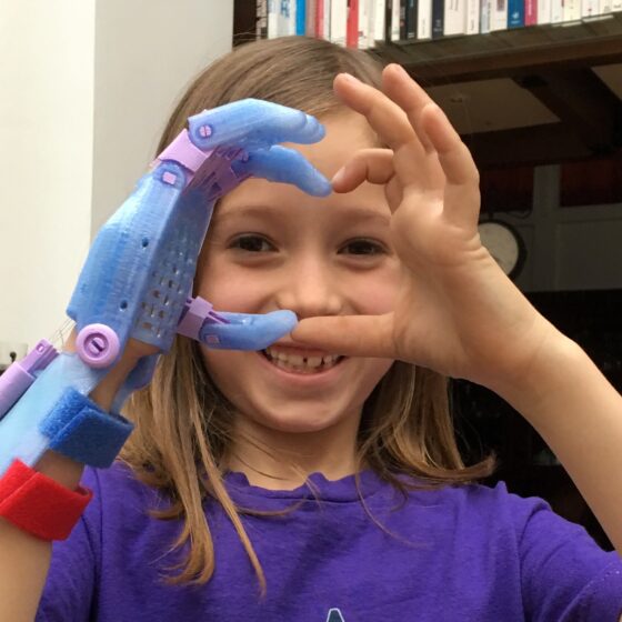 Petite fille faisant un coeur avec sa prothèse main 3D e-Nable